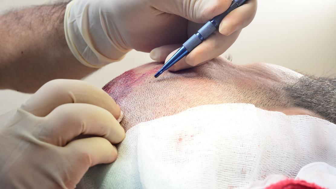 Vignette du programme télé Le succès des implants capillaires